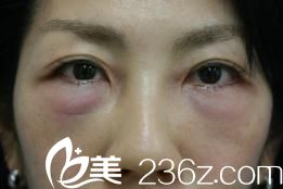 手術(shù)1天后 手術(shù)1天后