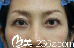 手術(shù)一個(gè)月左右 手術(shù)一個(gè)月左右