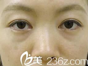 祛眼袋手術(shù)前正面展示 祛眼袋手術(shù)前正面展示