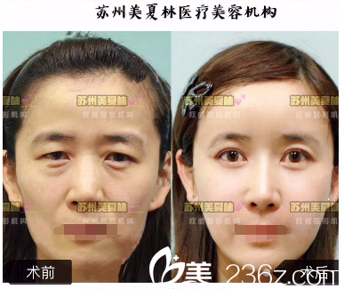 雙12買買買不如到蘇州美夏林整形變美 優(yōu)惠項(xiàng)目價(jià)格表芭比眼綜合4680元面部吸脂680元