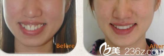 成人齙牙矯正案例及臉型變化圖