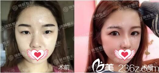 林曉燕眼部整形真人前后效果對(duì)比