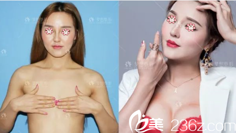 昆明夢(mèng)想豐胸效果好不好