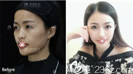 昆明夢(mèng)想自體脂肪面部填充效果怎么樣