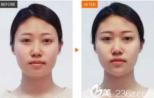 常德伊麗莎白玻尿酸注射下巴真人案例