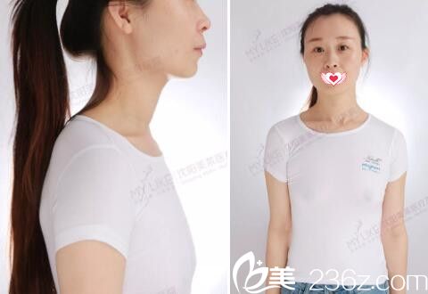 做圓形假體豐胸術(shù)前照 做圓形假體豐胸術(shù)前照