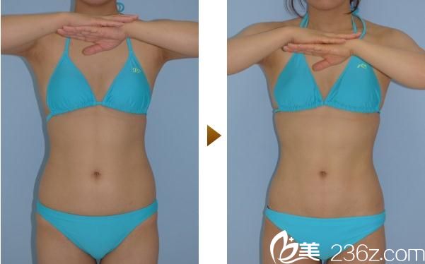 內(nèi)浦康信腹部吸脂