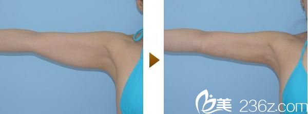 內(nèi)浦康信手臂吸脂