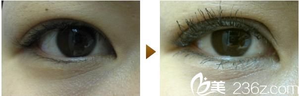 內(nèi)浦康信雙眼皮手術(shù)