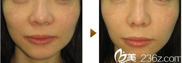 內(nèi)浦康信鼻尖縮小術(shù)