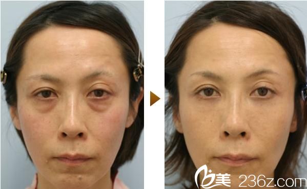百澤明祛除眼部重度松弛 百澤明祛除眼部重度松弛