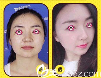 鄭州醫(yī)德佳整形醫(yī)院面部提升案例