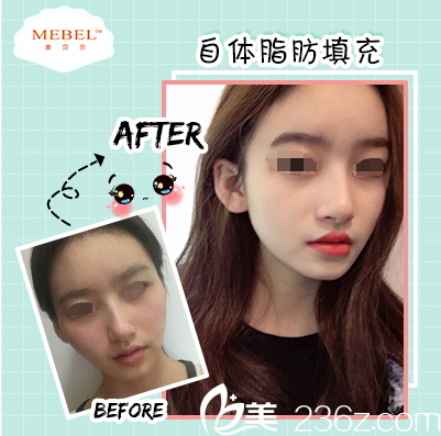 蘇州美貝爾自體脂肪填充案例