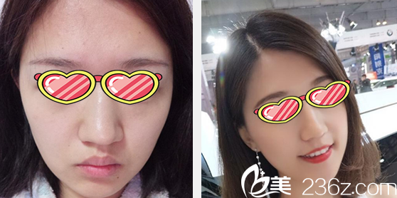 蘭州仁和劉慶陽(yáng)自體脂肪面部填充前后效果對(duì)比 蘭州仁和劉慶陽(yáng)自體脂肪面部填充前后效果對(duì)比