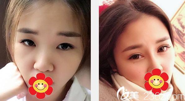 蘭州仁和劉慶陽(yáng)全切雙眼皮+臥蠶整形效果案例 蘭州仁和劉慶陽(yáng)全切雙眼皮+臥蠶整形效果案例