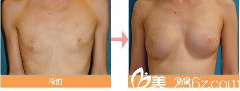 院長(zhǎng)巖平佳子豐胸術(shù) 院長(zhǎng)巖平佳子豐胸術(shù)