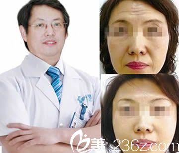 楚雄吳氏嘉美特邀醫(yī)生王毅超愛貝芙案例（注射除皺）圖