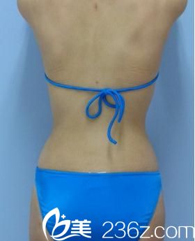 手術(shù)3個月后背面展示