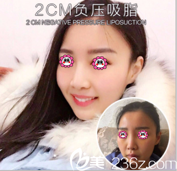 <!--<i data=20240703-sp></i>-->門診部張清峰面部吸脂案例 <!--<i data=20240703-sp></i>-->門診部張清峰面部吸脂案例