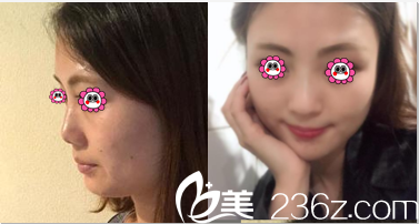 <!--<i data=20240703-sp></i>-->門診部閆立新鼻修復案例 <!--<i data=20240703-sp></i>-->門診部閆立新鼻修復案例