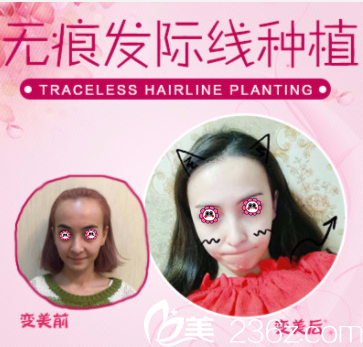 <!--<i data=20240703-sp></i>-->門診部高紅俠發(fā)際線種植案例 <!--<i data=20240703-sp></i>-->門診部高紅俠發(fā)際線種植案例