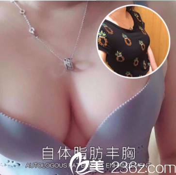 <!--<i data=20240703-sp></i>-->門診部張清峰自體脂肪豐胸案例 <!--<i data=20240703-sp></i>-->門診部張清峰自體脂肪豐胸案例