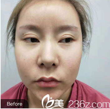 隆鼻術(shù)前照片 隆鼻術(shù)前照片