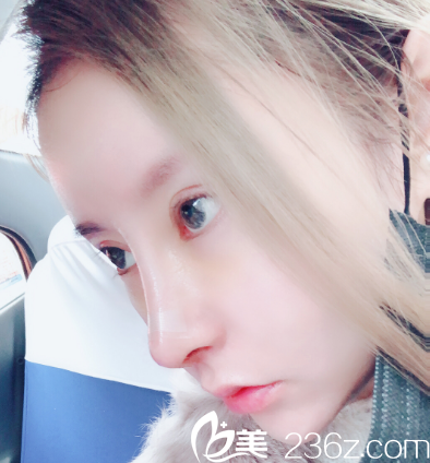 汕頭華美朱洙玉隆鼻術(shù)后7天拆線圖 汕頭華美朱洙玉隆鼻術(shù)后7天拆線圖