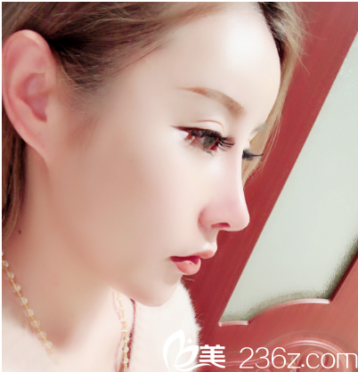 糾結(jié)汕頭華美和曙光哪個(gè)好,面診后去華美找朱洙玉做了隆鼻效果還不錯(cuò)