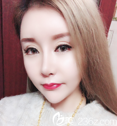 汕頭華美朱洙玉做的鼻綜合隆鼻案例 汕頭華美朱洙玉做的鼻綜合隆鼻案例