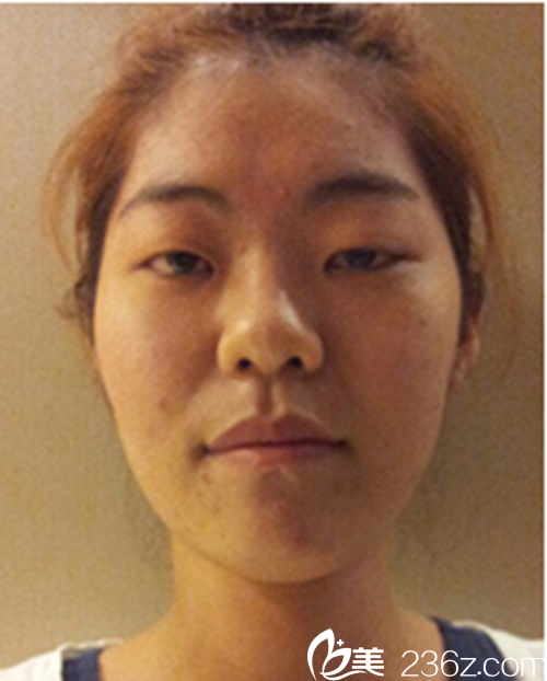 韓國新帝瑞娜醫(yī)院眼部+鼻部+脂肪填充術(shù)前 韓國新帝瑞娜醫(yī)院眼部+鼻部+脂肪填充術(shù)前