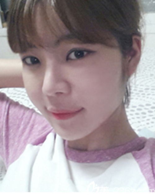 韓國新帝瑞娜醫(yī)院眼部+鼻部+脂肪填充術(shù)后1個月后 韓國新帝瑞娜醫(yī)院眼部+鼻部+脂肪填充術(shù)后1個月后