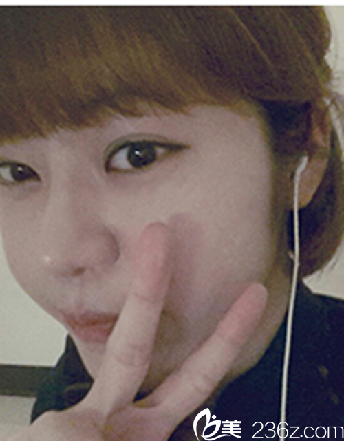 韓國新帝瑞娜醫(yī)院眼部+鼻部+脂肪填充術(shù)后1個月后 韓國新帝瑞娜醫(yī)院眼部+鼻部+脂肪填充術(shù)后1個月后