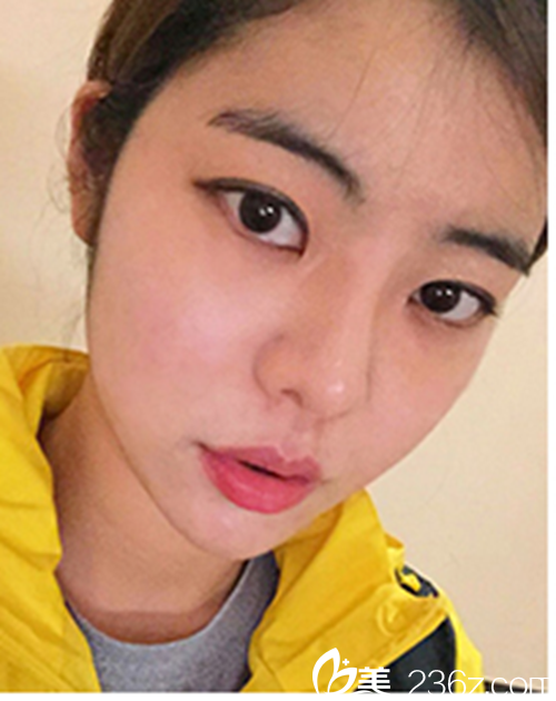 韓國新帝瑞娜醫(yī)院眼部+鼻部+脂肪填充術(shù)后3個月后 韓國新帝瑞娜醫(yī)院眼部+鼻部+脂肪填充術(shù)后3個月后