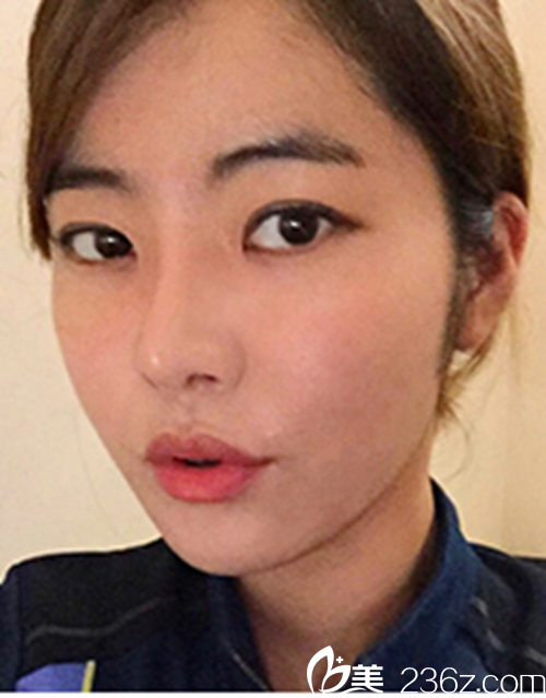 韓國新帝瑞娜醫(yī)院眼部+鼻部+脂肪填充術(shù)后3個月后 韓國新帝瑞娜醫(yī)院眼部+鼻部+脂肪填充術(shù)后3個月后