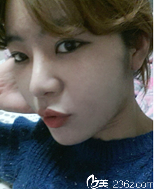 韓國新帝瑞娜醫(yī)院眼部+鼻部+脂肪填充術(shù)后5個月后 韓國新帝瑞娜醫(yī)院眼部+鼻部+脂肪填充術(shù)后5個月后