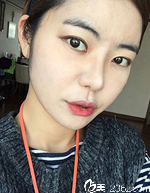 眼睛脫“單”我也脫單了，半年見證韓國新帝瑞娜醫(yī)院的芭比混血美眸