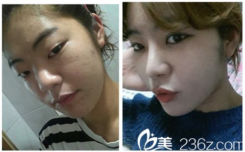 韓國新帝瑞娜醫(yī)院眼部+鼻部+脂肪填充術(shù)前術(shù)后對比圖 韓國新帝瑞娜醫(yī)院眼部+鼻部+脂肪填充術(shù)前術(shù)后對比圖