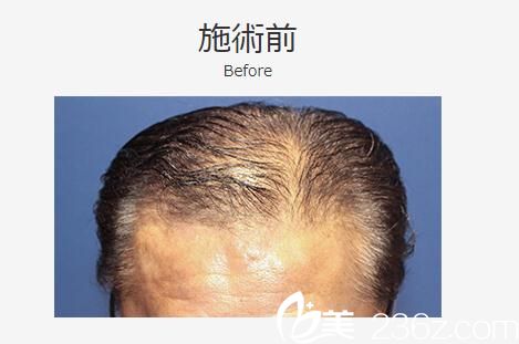 植發(fā)前 植發(fā)前