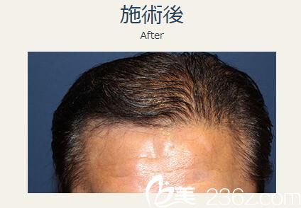 日本哪家植發(fā)醫(yī)院好?我在日本親和植發(fā)診療醫(yī)院音田正光醫(yī)生那里進(jìn)行了自發(fā)植發(fā)