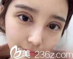 現(xiàn)在的眼睛雖然寬但是整形 現(xiàn)在的眼睛雖然寬但是整形