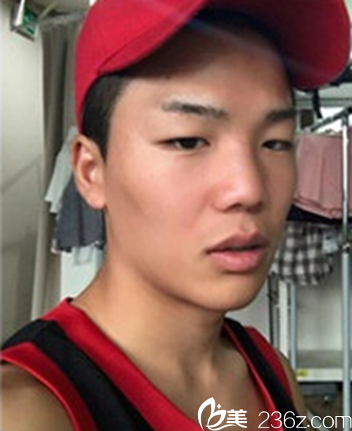 韓國(guó)新帝瑞娜醫(yī)院鼻部+眼睛矯正術(shù)前 韓國(guó)新帝瑞娜醫(yī)院鼻部+眼睛矯正術(shù)前