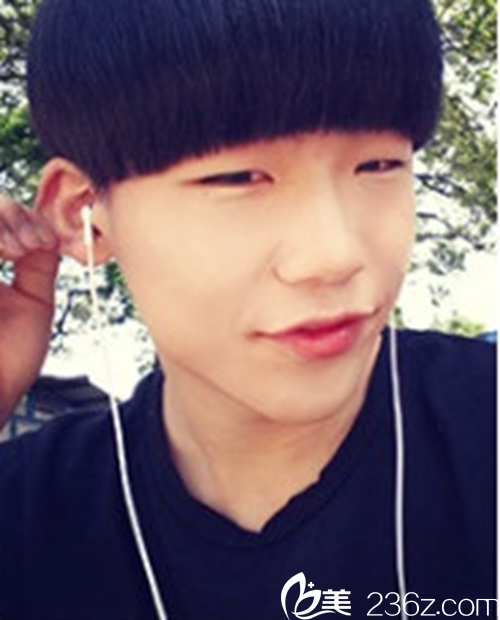 2韓國(guó)新帝瑞娜醫(yī)院鼻部+眼睛矯正術(shù)前 2韓國(guó)新帝瑞娜醫(yī)院鼻部+眼睛矯正術(shù)前