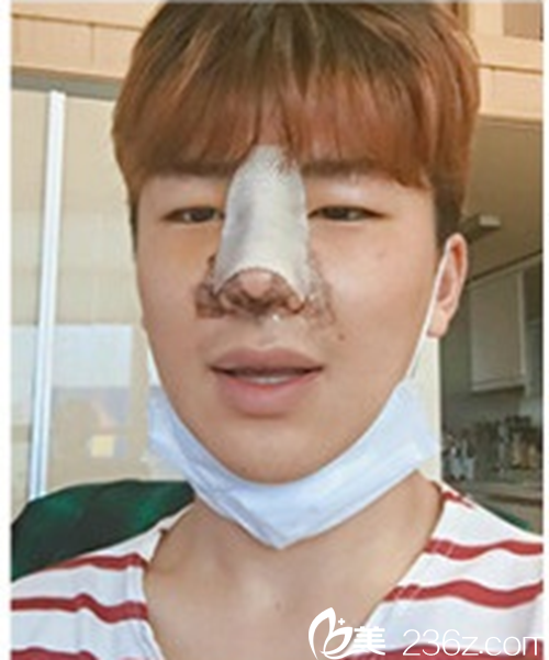 韓國(guó)新帝瑞娜醫(yī)院鼻部整形術(shù)后 韓國(guó)新帝瑞娜醫(yī)院鼻部整形術(shù)后