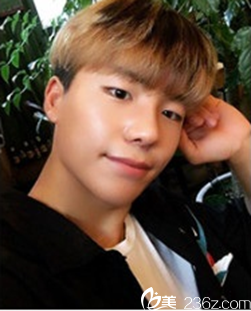 韓國(guó)新帝瑞娜醫(yī)院鼻部整形術(shù)后 韓國(guó)新帝瑞娜醫(yī)院鼻部整形術(shù)后