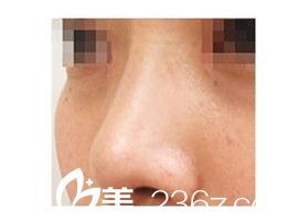 分享品川美容外科醫(yī)院線雕隆鼻經(jīng)歷，找照屋智醫(yī)生為我做的高挺鼻梁