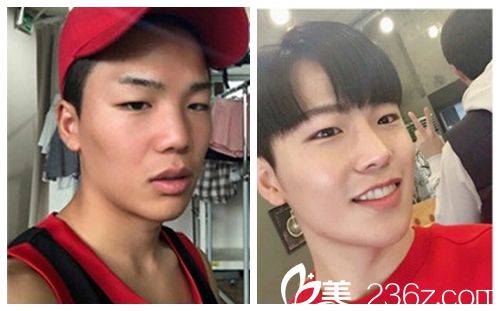 韓國(guó)新帝瑞娜醫(yī)院鼻部+眼睛矯正術(shù)前術(shù)后對(duì)比圖 韓國(guó)新帝瑞娜醫(yī)院鼻部+眼睛矯正術(shù)前術(shù)后對(duì)比圖