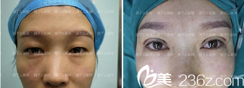 顏?zhàn)釉齐p眼皮術(shù)后即刻對比