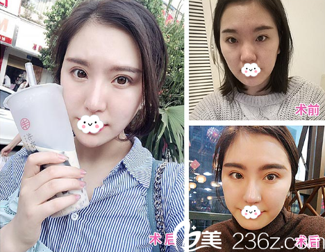 成都銅雀臺整形美容醫(yī)院雙眼皮案例 成都銅雀臺整形美容醫(yī)院雙眼皮案例