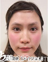 講講我在品川美容外科醫(yī)院找照屋智醫(yī)生的天然法埋線雙眼皮，真的是天然去雕飾